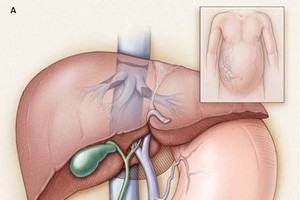 布加综合症多发于青年男性
