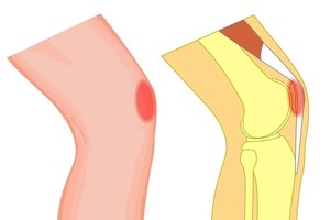 年轻人膝关节痛须当心