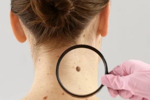 皮肤黑痣要警惕癌变