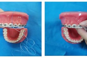 牙齿矫正期间控制牙菌斑方法