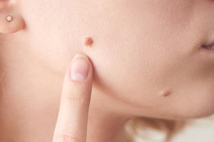 “脸上凸一颗”吓坏还会长大！