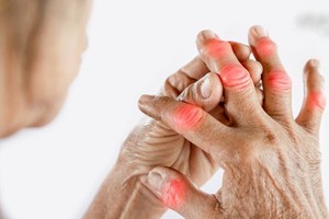 类风湿性关节炎症状、成因、预防、治疗？