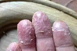 大扫除手脱皮好痛？