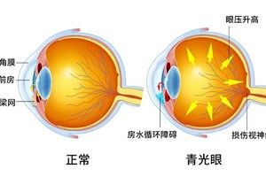“视力小偷”症状隐蔽 眼科检查很有必要