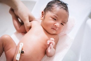 孩子满月脐带还未脱落或是免疫缺陷？