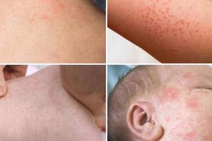 麻疹病治疗专家小组成立