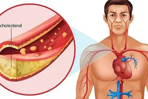 高胆固醇血症：沉默的健康隐患