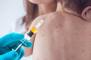 疫苗接种是主动预防麻疹的最有效方法。