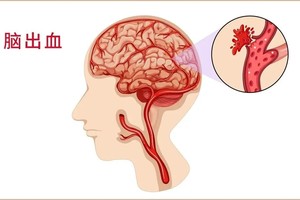 警惕脑出血！