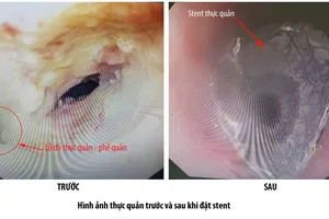 Lỗ dò thực quản - phế quản (ảnh trái) và thực quản - phế quản sau khi đặt Stent thực quản thành công