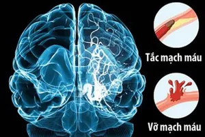 ĐBSCL: Mỗi năm có hơn 10.000 trường hợp đột quỵ