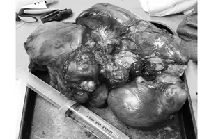 Phẫu thuật thành công khối u trung thất đến 4 kg