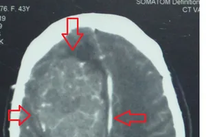 Phẫu thuật thành công khối u màng não lớn, nguy hiểm tính mạng