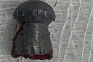 Thanh niên đi làm đồng bất ngờ bị trúng đạn xuyên dương vật