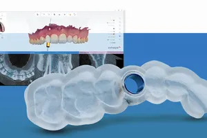 Ứng dụng công nghệ máng định vị kỹ thuật số DSG là công nghệ mang đến sự an toàn trong nha khoa hiện nay