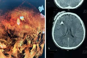 Hình ảnh CT và dựng hình 3D cho thấy vị trí dị vật ở vùng đầu nam sinh