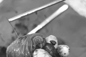 Podcast bản tin ANTT 24-9: Xương cá đâm thủng ruột non gây áp xe ổ bụng