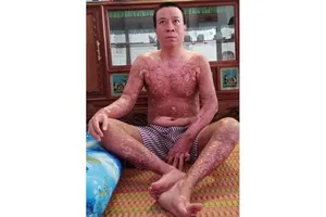 Tàn phế do xông vào lửa cứu người thân