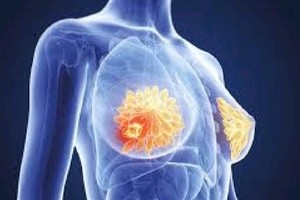 HCMC Oncology Hospital to provide free breast cancer screening for women