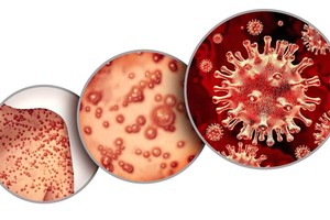 Monkeypox virus clades II found in HCMC’s first local case