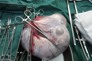 Phẩu thuật thành công lấy được khối u buồng trứng nặng 6 kg