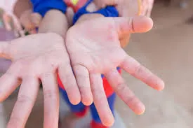 Bệnh tay chân miệng tăng 4,4 lần so với cùng kỳ tại Vĩnh Long