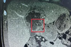 Hình ảnh dị vật trong gan bệnh nhân