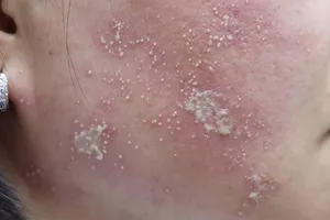 Cẩn thận viêm da do kiến ba khoang