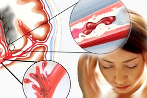 中风脑梗治好后会不会复发？