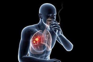 肺癌发病的首位高危因素是吸烟。