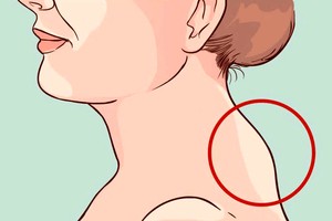 长时间保持不良姿势容易形成“富贵包”。