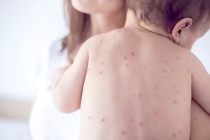 欧洲区域麻疹病例数创下近 30 年来新高