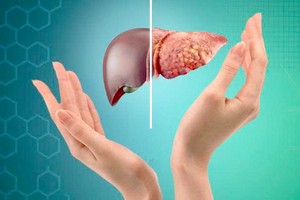 脂肪肝若没有得到适切治疗，会发展成致命的肝病。