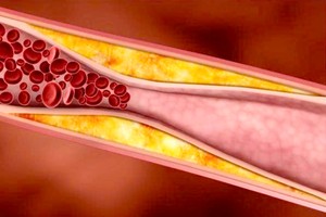 近年来，临床动脉粥样硬化斑块检出率越来越高。