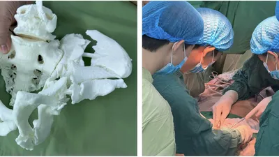 Ứng dụng công nghệ in 3D để tái tạo chính xác cấu trúc khung chậu của người bệnh trước mổ 