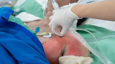 Vụ cháy nhà ở phường Chợ Lớn: Nhiều nạn nhân bị bỏng hô hấp 