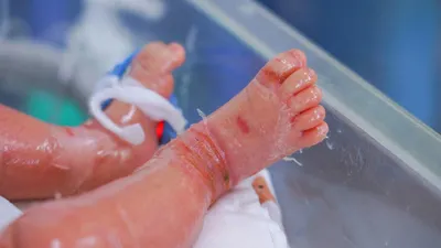Bé sơ sinh mắc bệnh hiếm gặp, da bong như vảy cá 