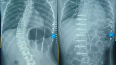 Phim X-quang cột sống của bệnh nhi trước và sau phẫu thuật. Ảnh: AN NGỌC