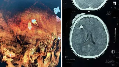 Hình ảnh CT và dựng hình 3D cho thấy vị trí dị vật ở vùng đầu nam sinh