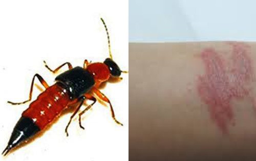 “Vào mùa” kiến ba khoang, nhiều người bị phỏng da, lở loét