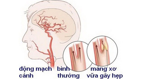 Chớ coi thường bệnh hẹp động mạch cảnh