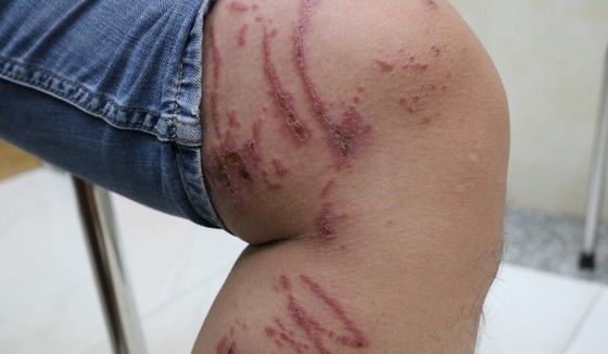 A man is attacked by rove beetle in the leg (Photo: SGGP)