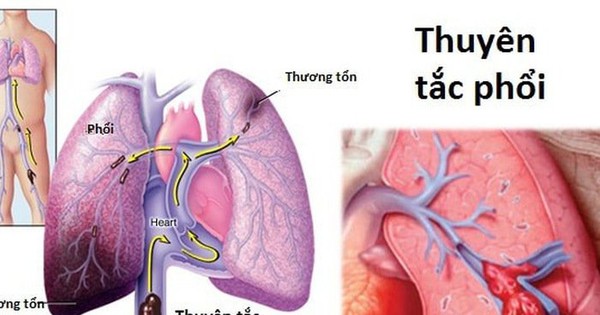 警惕沉寂的殺手急性肺栓塞 健康 飲食 華文西貢解放日報