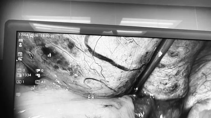 Quá trình nội soi cắt bỏ khối u