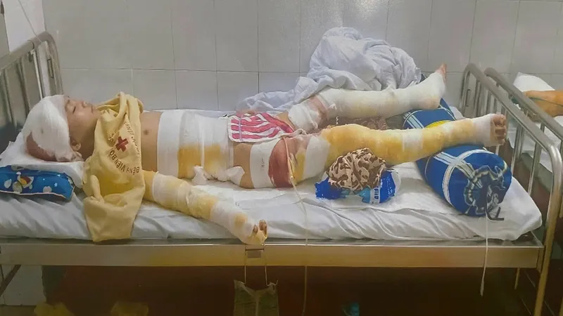 Cháu trai bị bỏng nặng không có tiền chữa trị