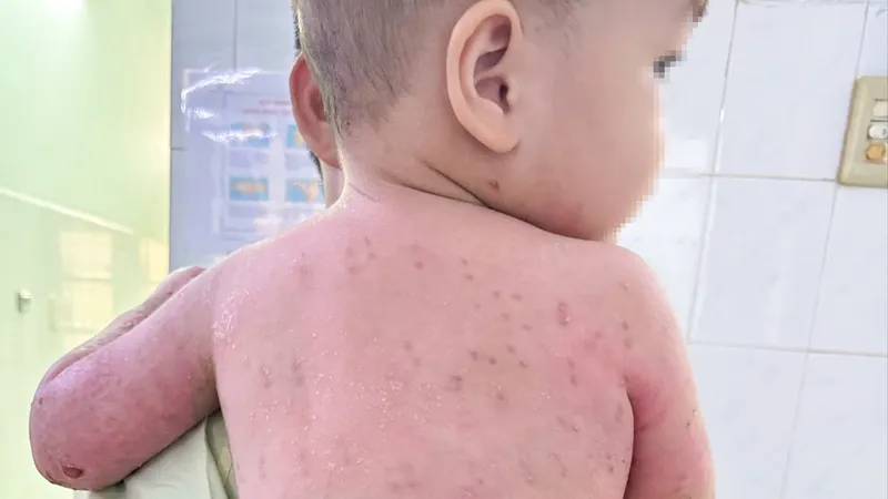 Cơ thể bé B.P.T trước ngày xuất viện. Kỹ thuật ghép da đã giúp vết phỏng hồi phục