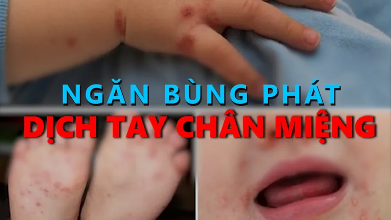 Ngăn bùng phát dịch tay chân miệng