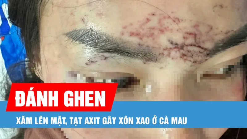 Podcast bản tin tối 8-5: Khởi tố vụ đánh ghen xăm lên mặt, tạt axit gây xôn xao ở Cà Mau