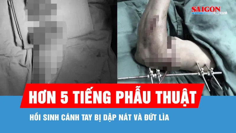 Hồi sinh cánh tay đứt lìa, dập nát do tai nạn lao động