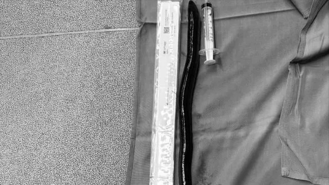 Con lươn dài 30cm trong ổ bụng một bệnh nhân